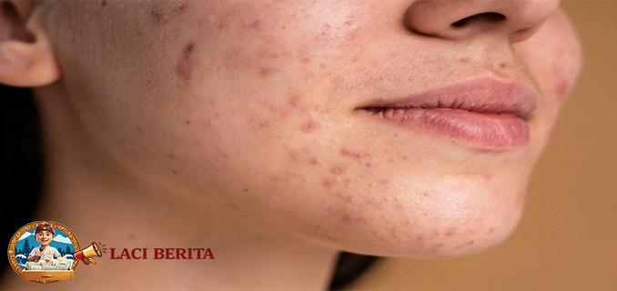 7 Jenis Makanan yang Memperburuk Kondisi Jerawat dan Perlu Dibatasi